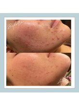 ラシュレ(BEAUTY CONCIERGE RASSURER)/ニキビ、赤み、凸凹にND-R！