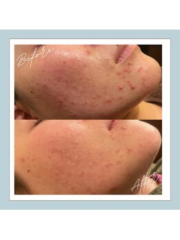 ラシュレ(BEAUTY CONCIERGE RASSURER)/ニキビ、赤み、凸凹にND-R！