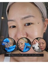 水光ピールスキン 池袋