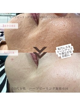 ジュエルカラーズ(JEWEL COLORS)の写真/【シミしわ改善】あきらめていた肌悩みに。とげの力でターンオーバーを促進し未来の美肌を作る◎