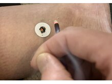 一二三鍼灸マッサージ治療院/【知熱灸】一例