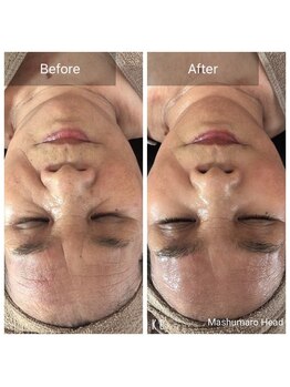 マシュマロヘッド 目黒店(Mashumaro Head)/超高濃度ヒト幹細胞培養液導入☆