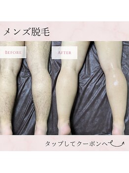 ゼロ(ZERO)/足脱毛☆before&after