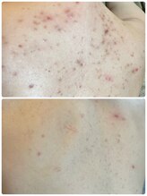 ストーリー(STORY)/ハーブピーリング専門店STORY