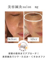 ミリグラム(mg)/【美容鍼灸９０分】