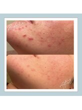 ラシュレ(BEAUTY CONCIERGE RASSURER)/ニキビ、赤み、凸凹にND-R！