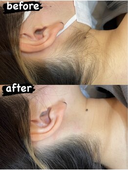ハグ(hug)/うなじのビフォーアフター♪