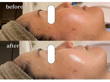 リスタ(RSTA)/【BEFORE/AFTER】