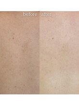 エステティックサロン ナチュラーレ/背中ニキビ・毛穴・ザラつき