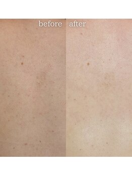 エステティックサロン ナチュラーレ/背中ニキビ・毛穴・ザラつき