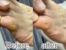 ポドロ(PoDoLo)/【小指上の魚の目】魚の目・大阪