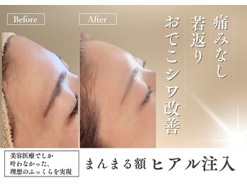 ポノティー(PONOTY)/エステでヒアルリッチ導入!