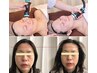 【小顔】人気No.1 オンダフェイス★別人級の変化！今世紀最後の小顔&引き上げ