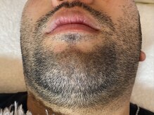 ベルシュドメール(Belle Sud Mer)/男性髭脱毛　施術前