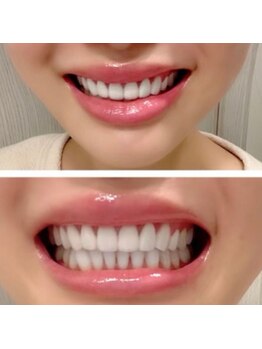 ライトビューティー 錦糸町店(lightbeauty)/セラミックレベルの白さへ