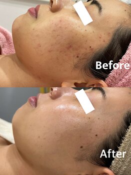 ジョアアンジェ 京橋店(joie ange)/ニキビケア