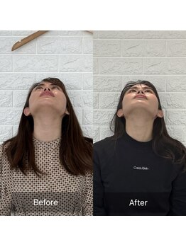 ティエル(Tielu)/小顔矯正6回の変化