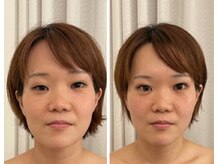 美人バスト 赤羽店/【小顔コルギ症例】