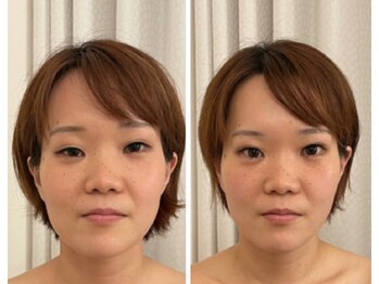 美人バスト 赤羽店/【小顔コルギ症例】