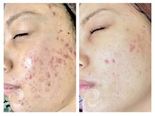 パルファンカルム 駅西本町店/ダウンタイムも短期間！