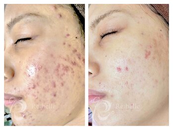 パルファンカルム 駅西本町店/ダウンタイムも短期間!