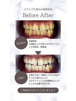 エクシアホワイト 平岸駅前店/ホワイトニング☆口コミのご紹介