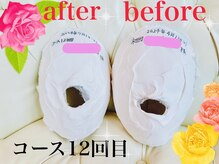 小顔矯正 アメリ ビューティーサロン(Ameri beauty salon)/石膏パックビフォーアフター