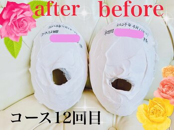 小顔矯正 アメリ ビューティーサロン(Ameri beauty salon)/石膏パックビフォーアフター