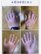 ナナラ(NANALA)/荒れた手の変化！