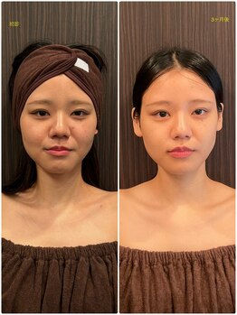 はる鍼灸整骨院/20代女性｜3ヶ月の結果