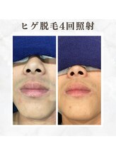 ボゴス(BOGOSS)/ヒゲ脱毛４回照射