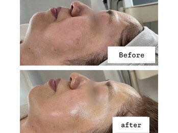 ルアンビューティー メディカルプラス(Luan beauty MEDICAL+)/【ビフォアフ】チタニウムリフト