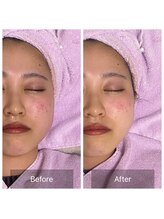 サロン ド パーフェクション(Salon de Perfection)/小顔リフト