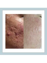 ラシュレ(BEAUTY CONCIERGE RASSURER)/ニキビ、赤み、凸凹にND-R！