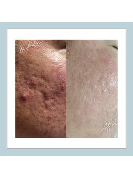 ラシュレ(BEAUTY CONCIERGE RASSURER)/ニキビ、赤み、凸凹にND-R！