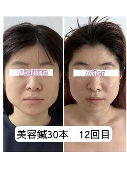 アネモネ 心斎橋院/リフトアップ小顔はこのメニュー