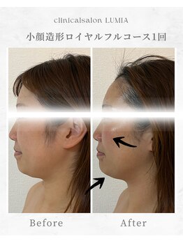 ルミア(LUMIA)/小顔造形ロイヤルフルコース１回