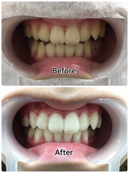ドクターモック(Dr.MOC)の写真/【高品質ジェル使用で理想の白さ◎】歯科提携だから満足度の高い実感!歯が白くなると肌も白く見えるかも!?
