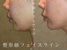 ルーツリー(Rootree)の雰囲気（糸リフト級のフェイスライン＊小顔/二重あご/ゴルゴライン）
