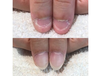 深爪改善コース　美爪育成の自爪です。3ヶ月経過のお写真です。