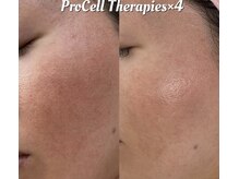 ルチル(Rutile)/プロセルセラピーズフェイシャル