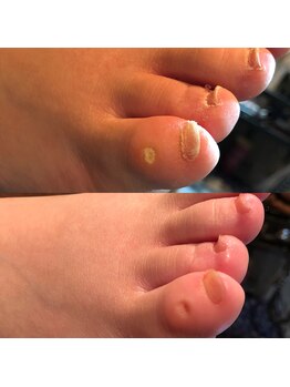 ルクプル(Le Couple)/小指の魚の目1