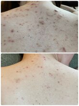 ストーリー(STORY)/ハーブピーリング専門店STORY