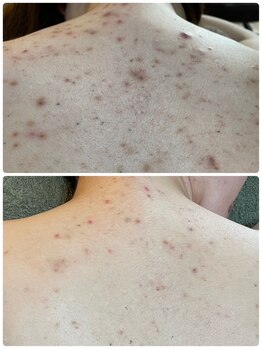 ストーリー(STORY)/ハーブピーリング専門店STORY