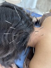 せせらぎ鍼灸院/首こり ピンポイントに狙います