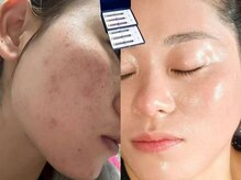 ミニ(MINI)/スピダイヤ毛穴ケア