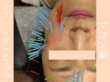 健志接骨院/太く多い鍼、マロン鍼！