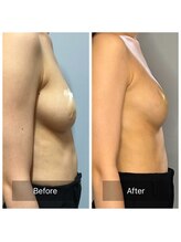 メイ(May)/20代　下垂ケア　未授乳