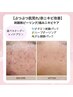 【ぶつぶつ肌荒れ/赤ニキビ改善】剥離無ピーリング/痛みニキビケアに¥19000→