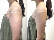 レシェルサロン(Lechelle Salon)/レモンボトル脂肪分解　二の腕